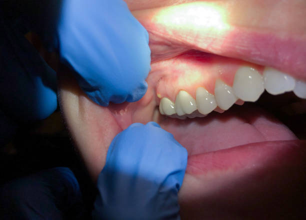 Best Emergency Dentist for Lost Fillings or Crowns in Bristol, TN